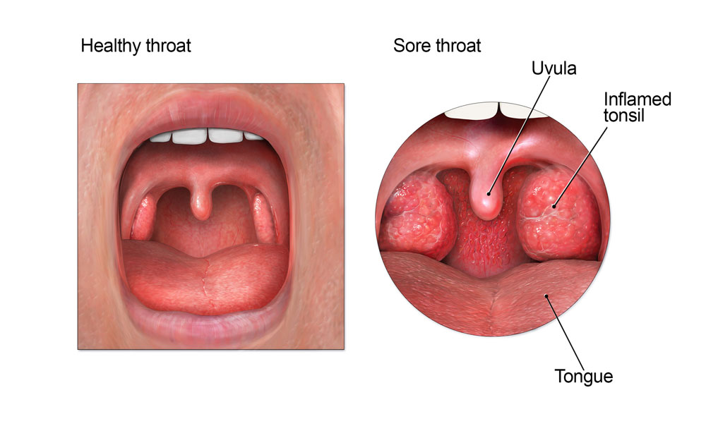 Sore throat illustration CDC