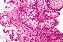 A high magnification micrograph of "cryptitis" in a case of Crohn's disease, colorized with an H&E stain and enhanced with post-processing. (Courtesy Wikimedia author Nephron)